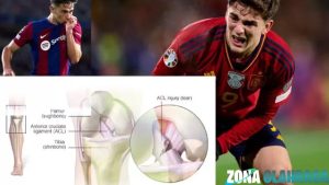 Pelatih Spanyol Gavi Wajib Dead Operasi Lutut 1X Segera